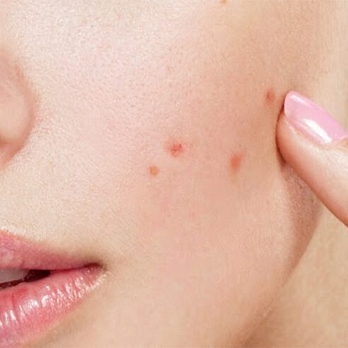 blog-acne-pic1