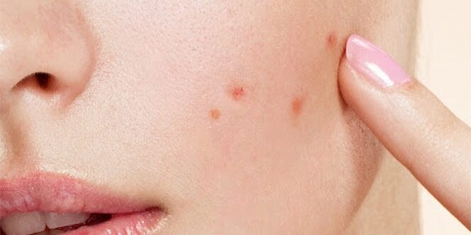 blog-acne-pic1