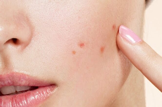 blog-acne-pic1