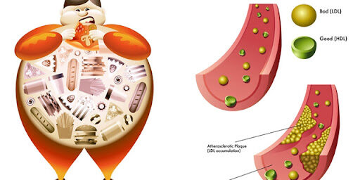 ภาวะคอเลสเตอรอลสูง