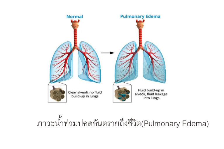 ภาวะนำท่วมปอดอันตรายถึงชีวิต(Pulmonary Edema)