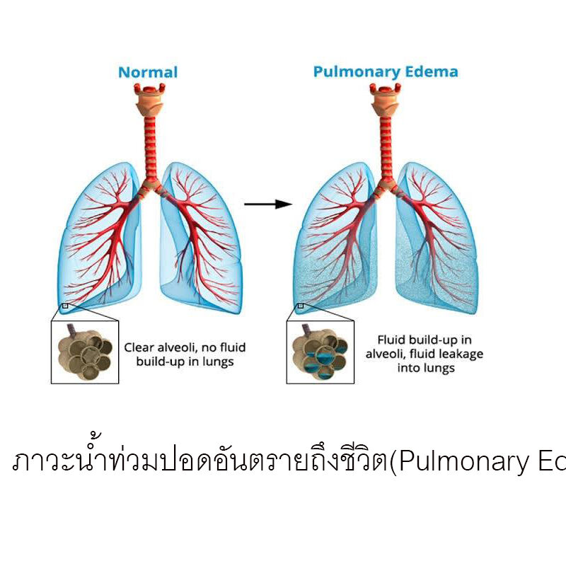 ภาวะนำท่วมปอดอันตรายถึงชีวิต(Pulmonary Edema)