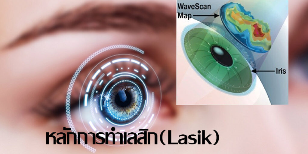 หลักการทำเลสิก(Lasik)