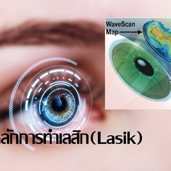 หลักการทำเลสิก(Lasik) หลักการทำเลสิก(Lasik)