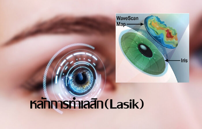 หลักการทำเลสิก(Lasik)