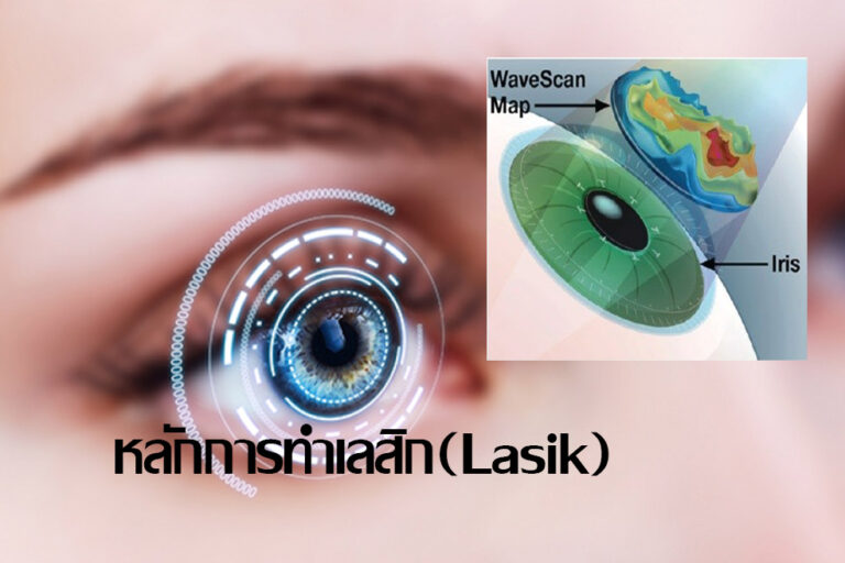 หลักการทำเลสิก(Lasik) หลักการทำเลสิก(Lasik)